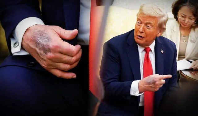 Trump presentó golpes en sus manos.    