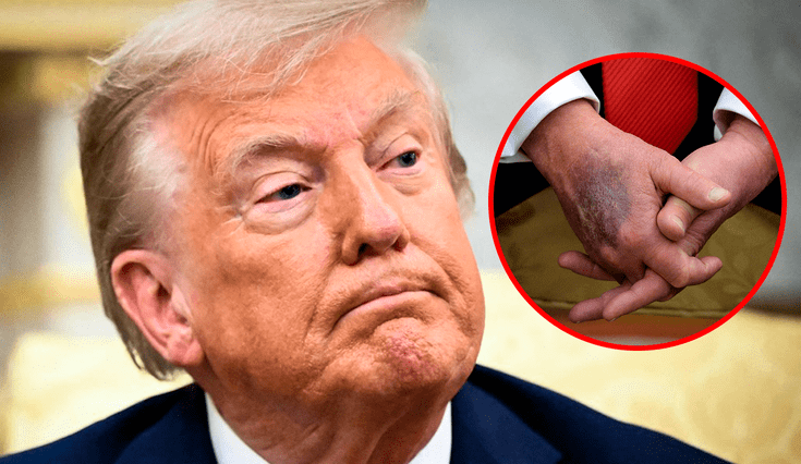 Donald Trump revela moretón en su mano durante un evento en la Sala Oval. Donald Trump revela moretón en su mano durante un evento en la Sala Oval.