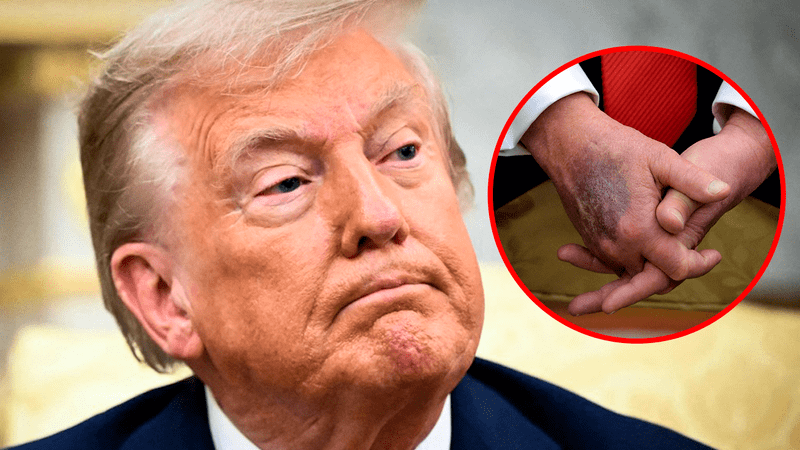 ¿Qué pasó con Donald Trump? Presidente de EEUU preocupa sobre su estado de salud tras mostrar moretón en su mano